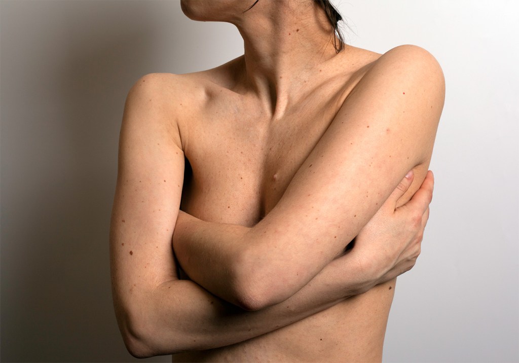 Petição online luta por tratamento para o câncer de mama metastático