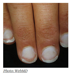 unhas manchas brancas
