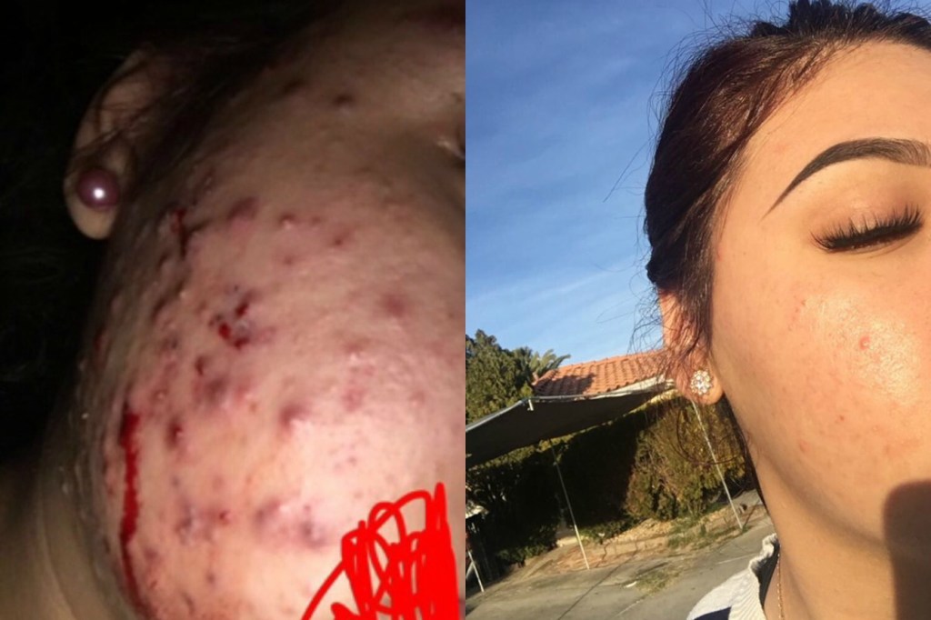 Ela tratou a acne no rosto com chá-verde e mel. Mas é seguro?