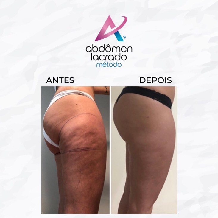 155232566_276458023895438_351216919477606370_n abdomen lacrado