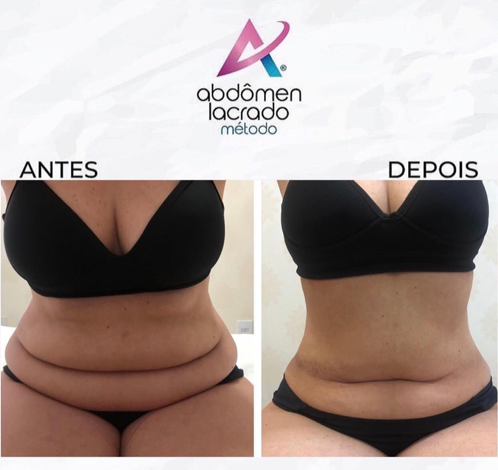 162659114_1184397848667736_1678698888284925734_n abdomen lacrado