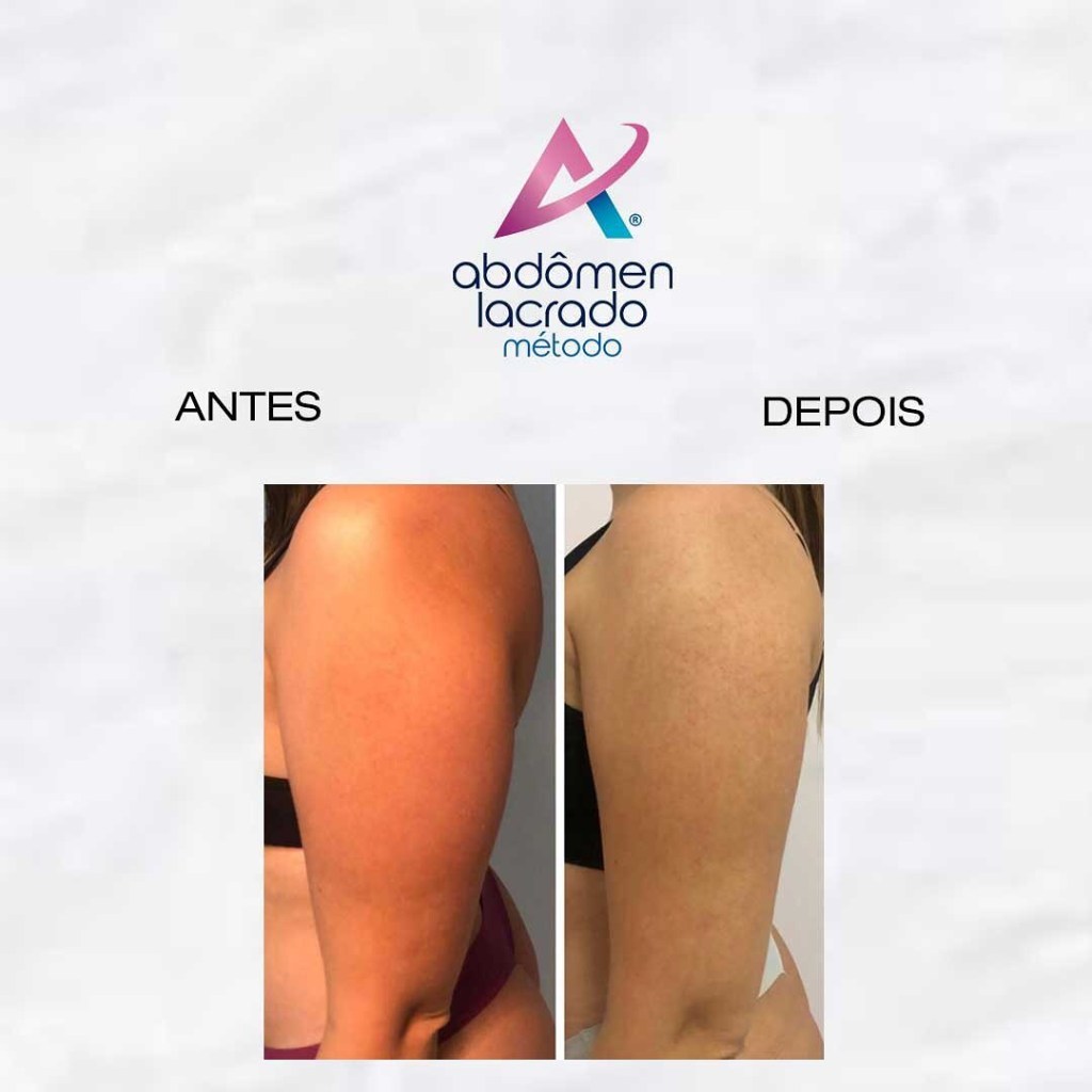 172174612_964104427728742_7625236595915401604_n abdomen lacrado