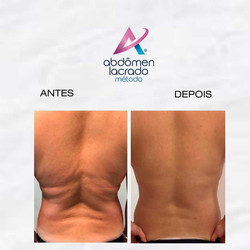 173431585_281093933643695_6585050411999586297_n abdomen lacrado