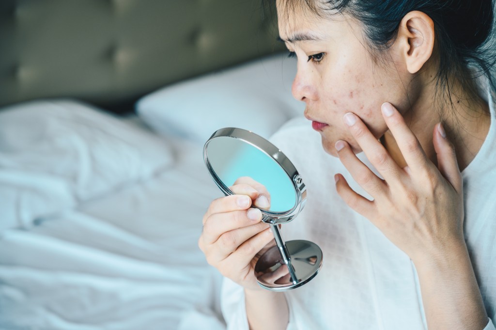 Guia da acne cosmética