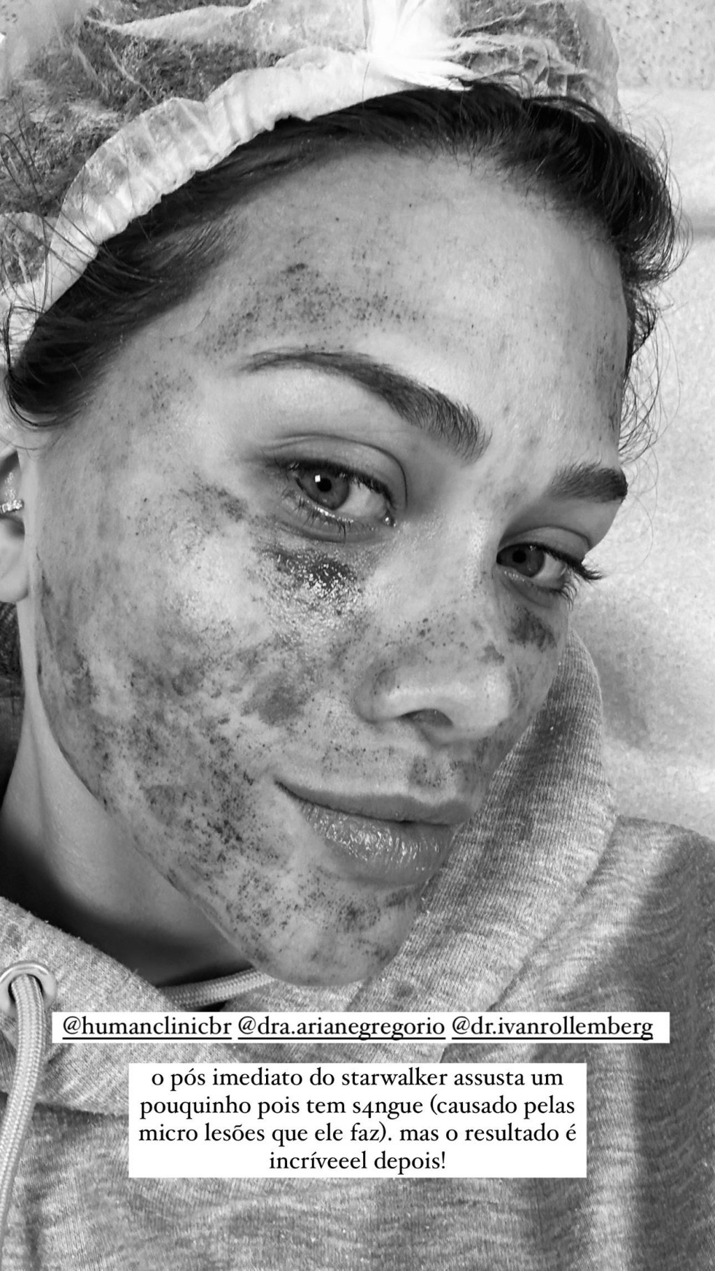 314749331_696541031543144_2558343728104216732_n Flavia Pavanelli com o rosto machucado após realização de laser