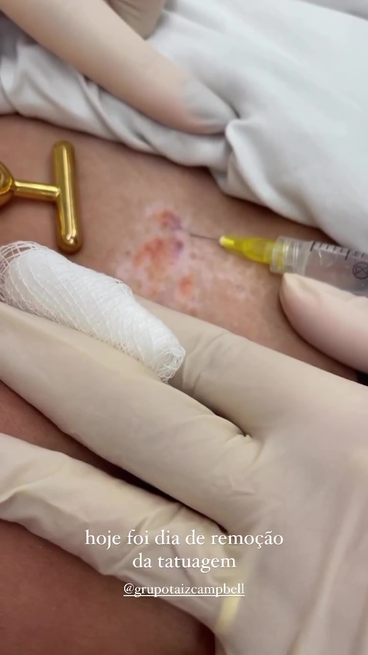 anestesia-mari Mari Gonzalez removendo tatuagem com laser