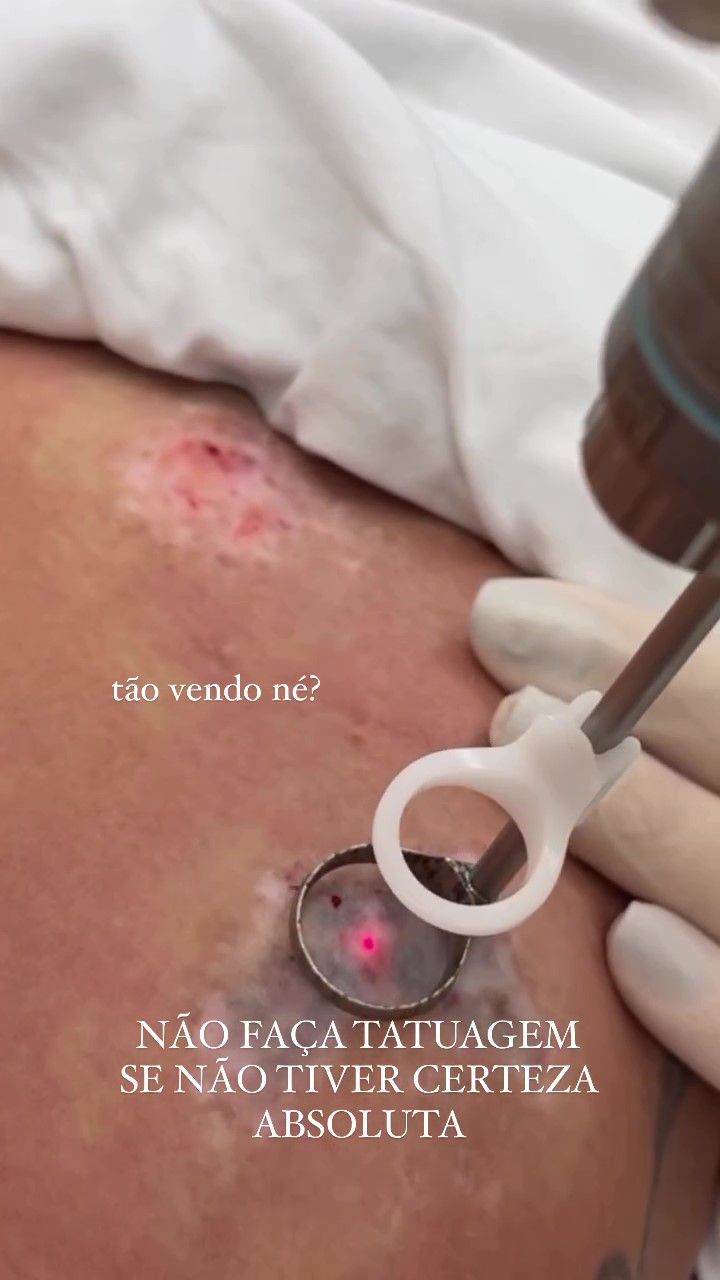 mari-gonzalez-tatuagem Mari Gonzalez removendo tatuagem com laser