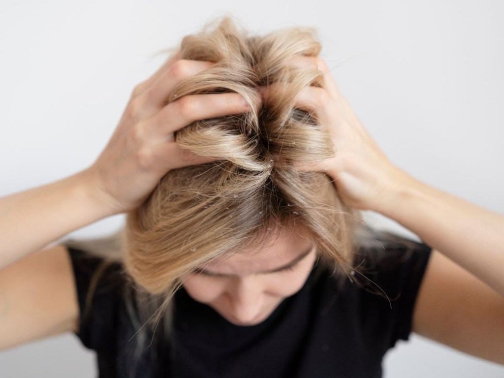 Pessoas com caspa podem ou não lavar o cabelo todos os dias?
