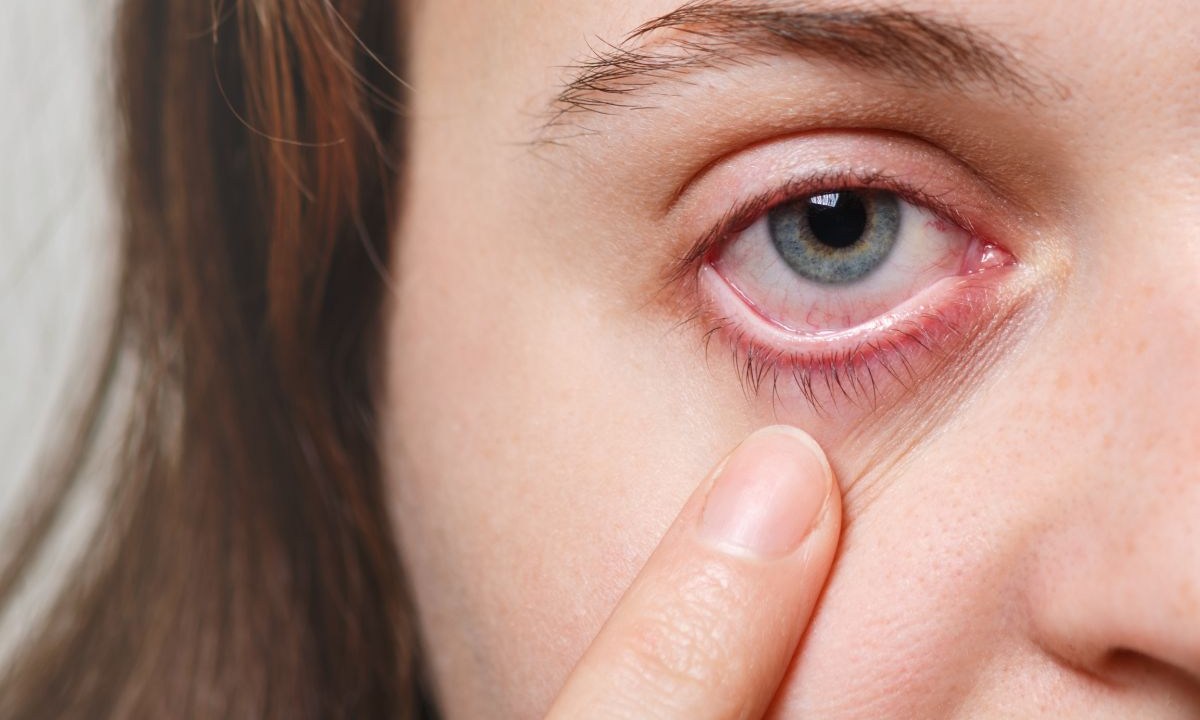 Olhos vermelhos