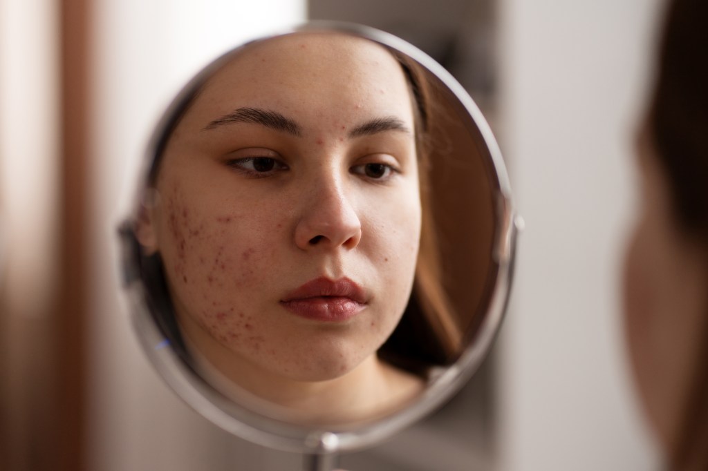 5 bebidas que podem eliminar a acne, segundo a ciência