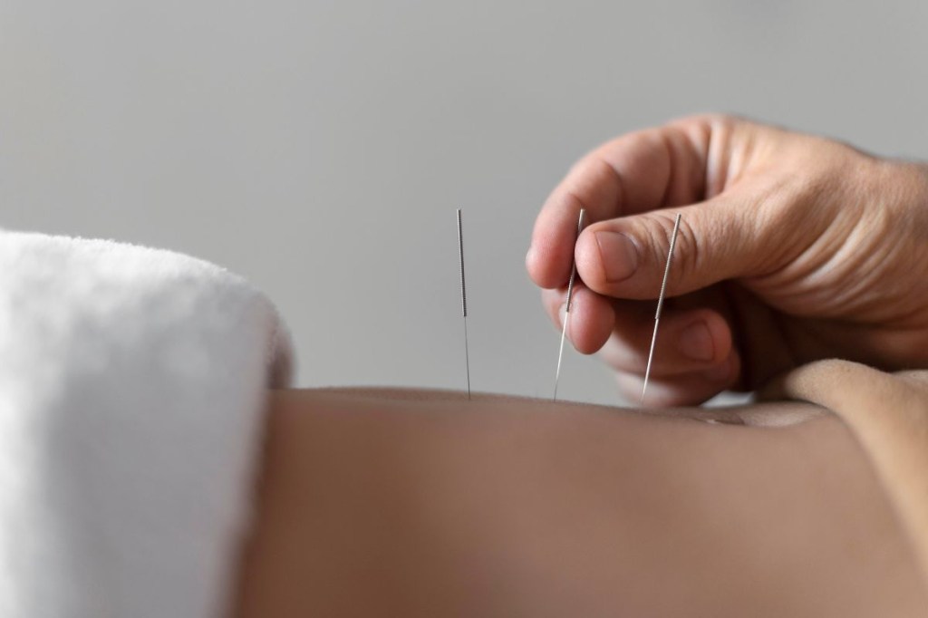 Para que serve a acupuntura?