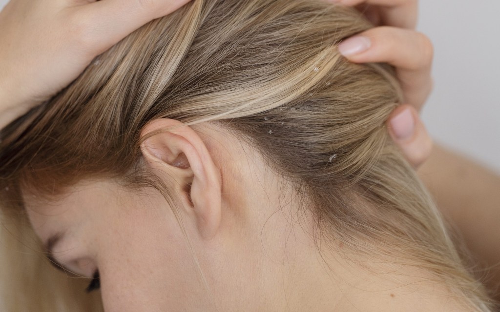 Dermatologista explica causas e tratamentos para caspa no inverno
