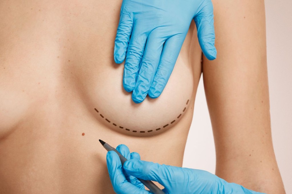 Implante de silicone na adolescência: é seguro? Especialista esclarece