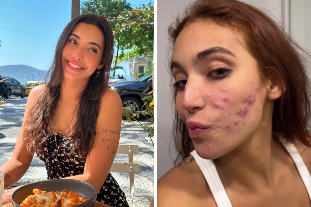 Roacutan: o que é o medicamento que Vanessa Lopes está tomando