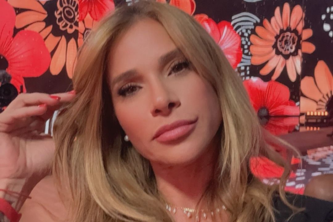 Dany Bananinha sofre contratura capsular, uma complicação nas próteses de silicone