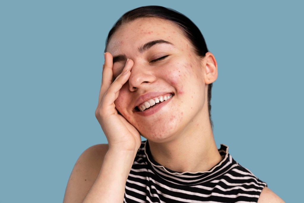 Aposte em bebidas anti-acne: 5 opções que sua pele vai agradecer