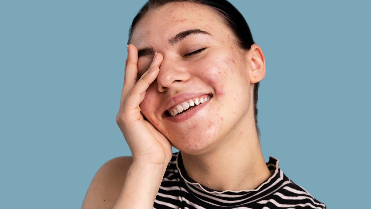 Confira quais bebidas as pesquisas apontaram como eficazes contra a acne