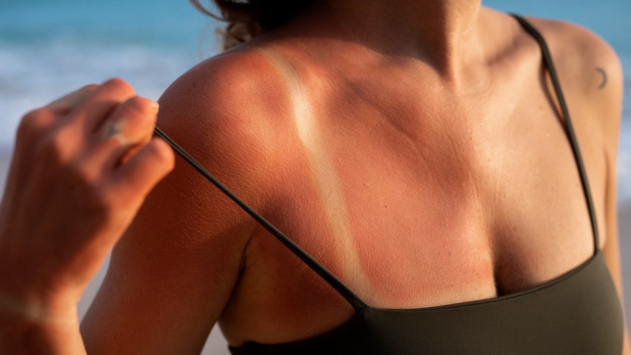 Confira diferentes opções de loções pós-sol para acalmar a pele