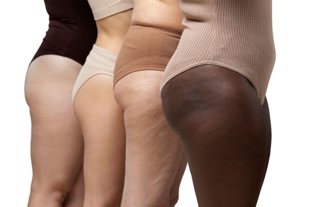 Entenda as diferenças entre obesidade e lipedema