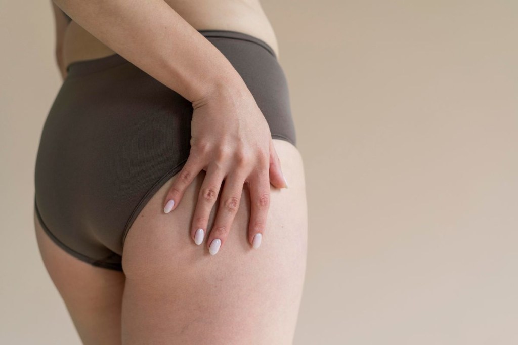 Lipedema: Entenda o distúrbio e descubra um plano de cuidados eficaz