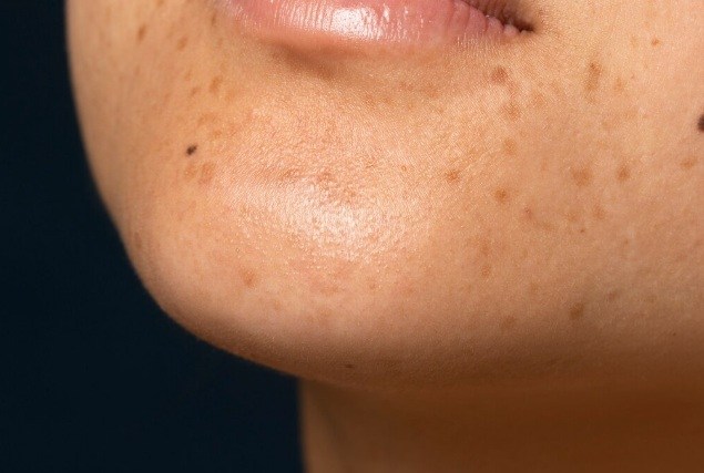 Melasma no Verão: entenda as causas e como cuidar da pele na estação mais quente do ano
